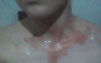 В Оренбурге девочка получила ожог, выполняя задания квеста