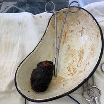 В Оренбурге у пенсионерки из кишки удалили камень из волос