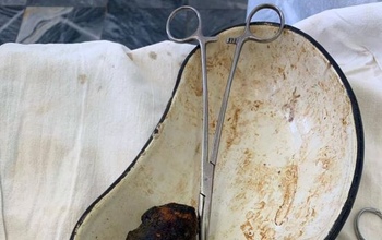 В Оренбурге у пенсионерки из кишки удалили камень из волос