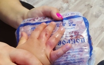 В Оренбурге трехлетний малыш едва не остался без пальцев