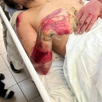 В Оренбурге мужчине после удара током ампутировали руку (18+)