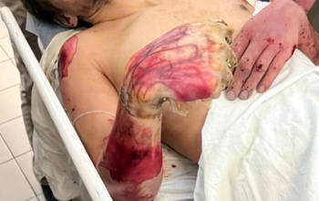 В Оренбурге мужчине после удара током ампутировали руку (18+)