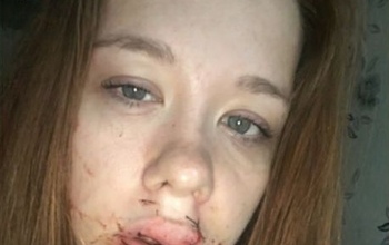 В Орске девушка пожаловалась, что муж выбил ей зубы и рассек губу (18+)