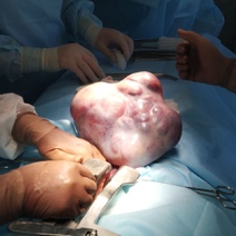 В Оренбурге у 14-летней девочки удалили огромную опухоль весом 3 кг (18+)