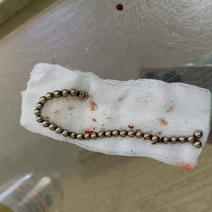 В Оренбурге двое малышей, проглотивших обойму магнитов, оказались на операционном столе