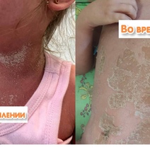 В Оренбурге в реанимацию попала девочка с сильнейшей аллергической реакцией на «Йодомарин» (18+)