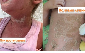 В Оренбурге в реанимацию попала девочка с сильнейшей аллергической реакцией на «Йодомарин» (18+)