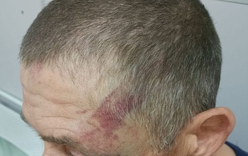 В Оренбурге мужчина избил пенсионера и натравил на него бойцовскую собаку