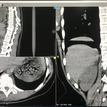 В Оренбурге ребенок сломал позвоночник, катаясь на качелях