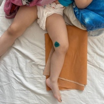 В Оренбурге девочка получила серьезный перелом ноги при падении с качелей