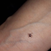 В Оренбуржье зафиксирован четвертый случай заболевания иксодовым клещевым боррелиозом