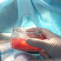 Оренбурженка вырастила в печени «чужого»