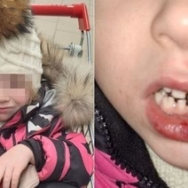 4-летняя оренбурженка в детском саду лишилась зубов