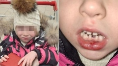 4-летняя оренбурженка в детском саду лишилась зубов