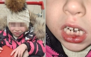 4-летняя оренбурженка в детском саду лишилась зубов