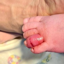 В Орске младенец мог лишиться пальца из-за маминого волоска 