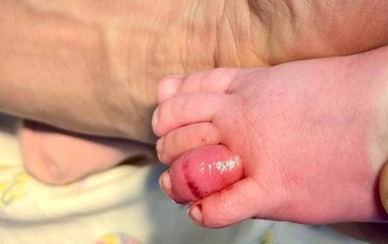 В Орске младенец мог лишиться пальца из-за маминого волоска 