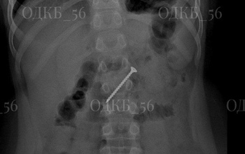 В Оренбурге врачи спасли ребёнка, проглотившего 5-сантиметровый саморез