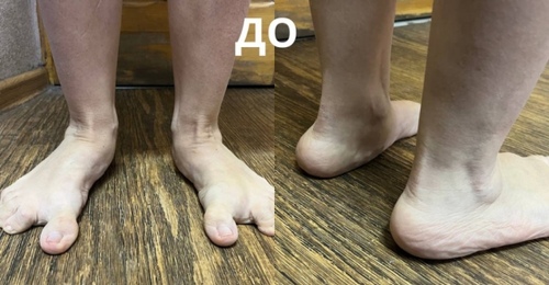 Оренбургские травматологи вернули походку пациентке с ДЦП