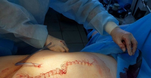 Бригада акбулакских хирургов спасла жизнь пациентке с ущемлением грыжи