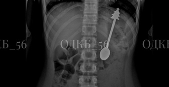 В Оренбурге врачи ОДКБ спасли ребёнка, проглотившего металлическую ложку