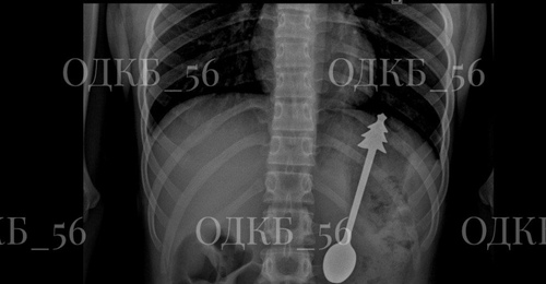 В Оренбурге врачи ОДКБ спасли ребёнка, проглотившего металлическую ложку