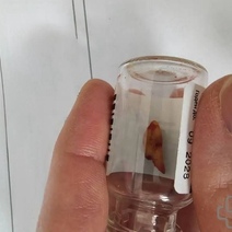 Житель Орска едва не задохнулся из-за зуба в носу