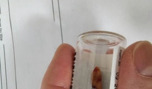 Житель Орска едва не задохнулся из-за зуба в носу