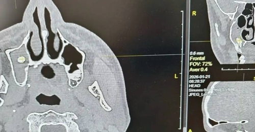 Житель Орска едва не задохнулся из-за зуба в носу