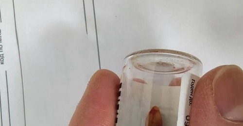 Житель Орска едва не задохнулся из-за зуба в носу