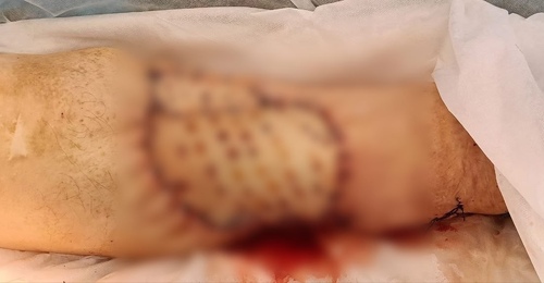 Орчанке удалили редкую и крупную опухоль на ноге