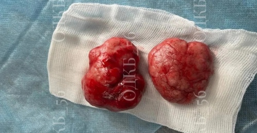 В Оренбурге в молочной железе школьницы образовались две опухоли