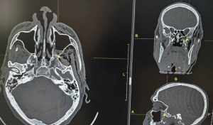 В Орске из головы мужчины извлекли пулю