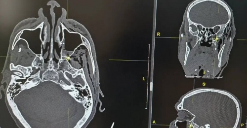 В Орске из головы мужчины извлекли пулю