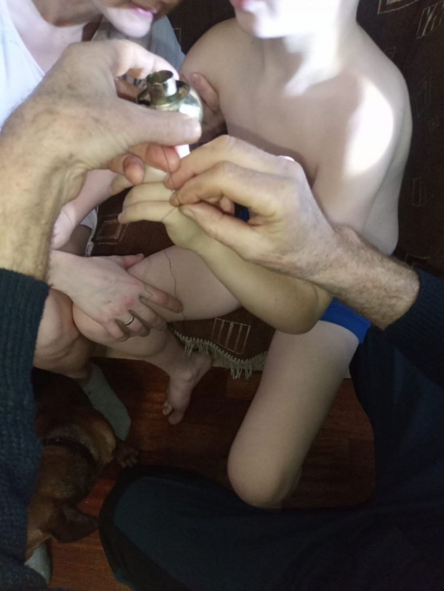 Лечение вывихов пальцев из суставов на руке в Клинике «Константа» в Ярославле